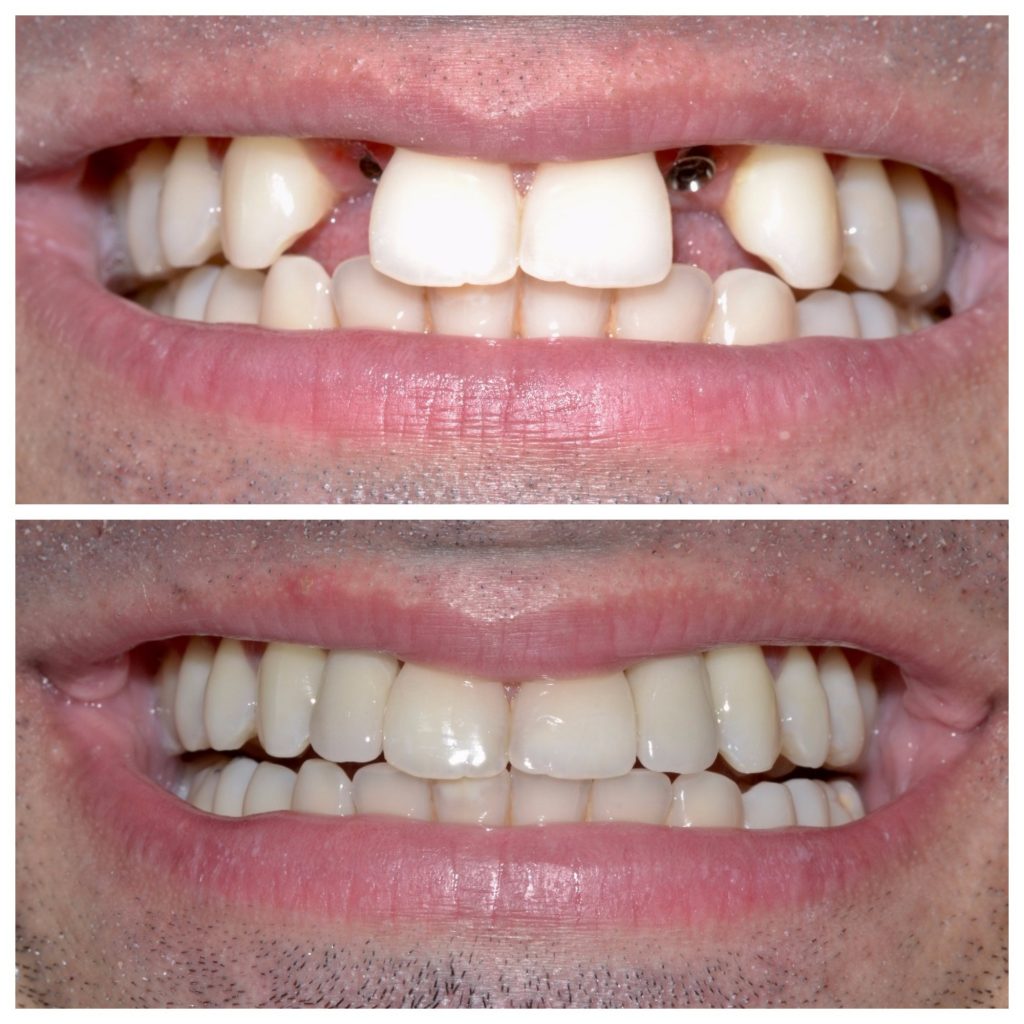 dental implants at Smile Brighter