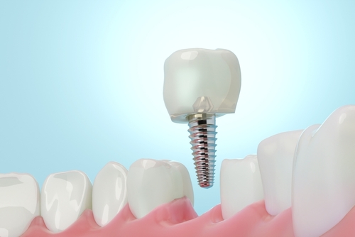 single tooth implant