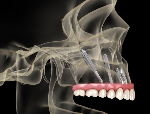 zygomatic dental implants